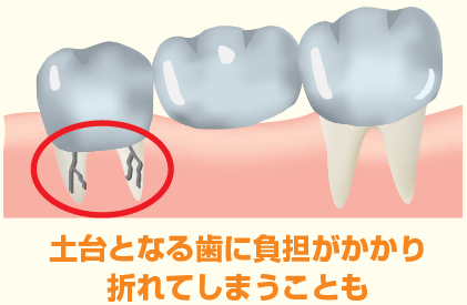 土台となる歯に負担がかかり折れてしまうことも