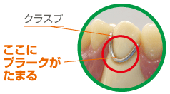 クラスプがたまる隙間