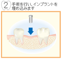 手術を行いインプラントを埋め込みます