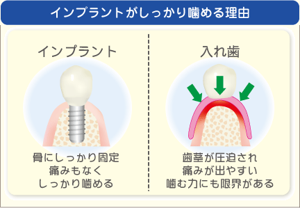 インプラントがしっかり噛める理由